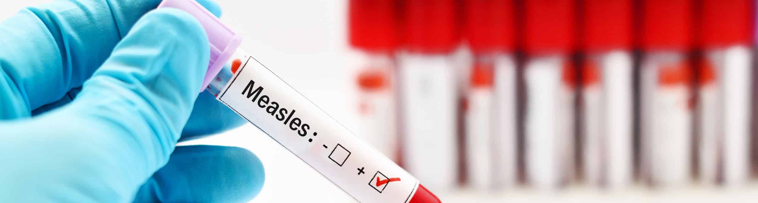 Measles Alert: Check Your Immunisation Status